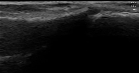 骨端軟骨エコー画像_小サイズ