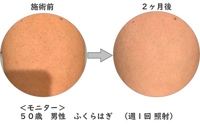 脱毛実例